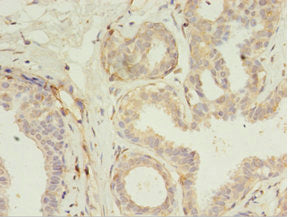 Immunohistochemistry of paraffin-embedded human breast cancer using RERG Antibody at dilution of 1:100