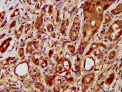 IHC image of LRRC45 Antibody diluted at 1:400 and staining in paraffin-embedded human pancreatic cancer performed on a Leica BondTM system. After dewaxing and hydration, antigen retrieval was mediated by high pressure in a citrate buffer (pH 6.0). Section was blocked with 10% normal goat serum 30min at RT. Then primary antibody (1% BSA) was incubated at 4°C overnight. The primary is detected by a biotinylated secondary antibody and visualized using an HRP conjugated SP system.