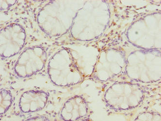 Immunohistochemistry of paraffin-embedded human colon cancer using RMDN1 Antibody at dilution of 1:100Rabbit anti-Human RMDN1 Polyclonal Antibody