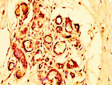 IHC image of OTUD5 Antibody diluted at 1:300 and staining in paraffin-embedded human breast cancer performed on a Leica BondTM system. After dewaxing and hydration, antigen retrieval was mediated by high pressure in a citrate buffer (pH 6.0). Section was blocked with 10% normal goat serum 30min at RT. Then primary antibody (1% BSA) was incubated at 4°C overnight. The primary is detected by a biotinylated secondary antibody and visualized using an HRP conjugated SP system.Rabbit anti-Human OTUD5 Polyclonal Antibody