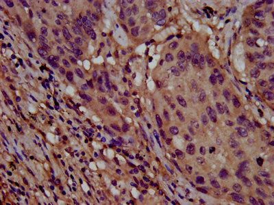 IHC image of CLPTM1L Antibody diluted at 1:800 and staining in paraffin-embedded human lung cancer performed on a Leica BondTM system. After dewaxing and hydration, antigen retrieval was mediated by high pressure in a citrate buffer (pH 6.0). Section was blocked with 10% normal goat serum 30min at RT. Then primary antibody (1% BSA) was incubated at 4°C overnight. The primary is detected by a biotinylated secondary antibody and visualized using an HRP conjugated SP system.Rabbit anti-Human CLPTM1L Polyclonal Antibody