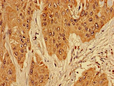 Immunohistochemistry of paraffin-embedded human cervical cancer using RPL10L Antibody at dilution of 1:100Rabbit anti-Human RPL10L Polyclonal Antibody