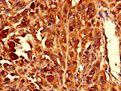 Immunohistochemistry of paraffin-embedded human melanoma using RPL10L Antibody at dilution of 1:100Rabbit anti-Human RPL10L Polyclonal Antibody
