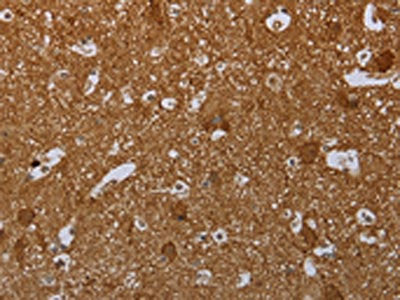 The image on the left is immunohistochemistry of paraffin-embedded Human brain tissue using the antibody Antibody) at dilution 1/40, on the right is treated with synthetic peptide. (Original magnification: ×200)