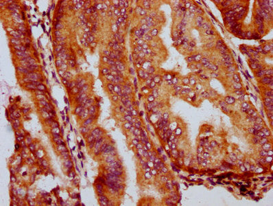 IHC image of GSDMA Antibody diluted at 1:400 and staining in paraffin-embedded human endometrial cancer performed on a Leica BondTM system. After dewaxing and hydration, antigen retrieval was mediated by high pressure in a citrate buffer (pH 6.0). Section was blocked with 10% normal goat serum 30min at RT. Then primary antibody (1% BSA) was incubated at 4°C overnight. The primary is detected by a biotinylated secondary antibody and visualized using an HRP conjugated SP system.Rabbit anti-Human GSDMA Polyclonal Antibody