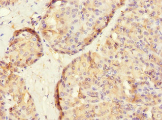 Immunohistochemistry of paraffin-embedded human pancreatic tissue using SLC2A13 Antibody at dilution of 1:100Rabbit anti-Human SLC2A13 Polyclonal Antibody