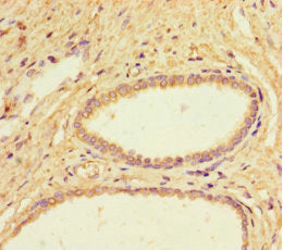 Immunohistochemistry of paraffin-embedded human prostate cancer using IL4I1 Antibody at dilution of 1:100Rabbit anti-Human IL4I1 Polyclonal Antibody