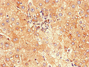 Immunohistochemistry of paraffin-embedded human liver cancer using CD177 Antibody at dilution of 1:100Rabbit anti-Human CD177 Polyclonal Antibody