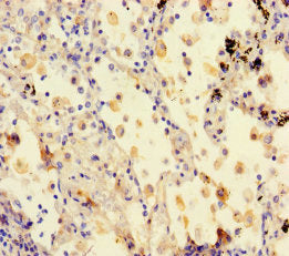 Immunohistochemistry of paraffin-embedded human lung cancer using STXBP6 Antibody at dilution of 1:100Rabbit anti-Human STXBP6 Polyclonal Antibody