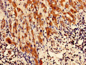 Immunohistochemistry analysis of human liver cancer using CFAP61 Antibody at dilution of 1:100Rabbit anti-Human CFAP61 Polyclonal Antibody