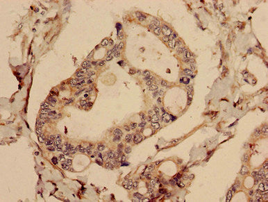Immunohistochemistry analysis of human pancreatic cancer using CFAP61 Antibody at dilution of 1:100Rabbit anti-Human CFAP61 Polyclonal Antibody