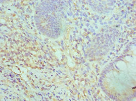 Immunohistochemistry of paraffin-embedded human colon cancer using the antibody at dilution of 1:100Rabbit anti-Human SMARCC2 Polyclonal Antibody