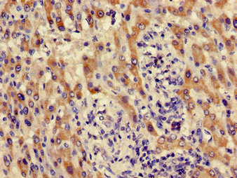 Immunohistochemistry of paraffin-embedded human liver cancer using ACMSD Antibody at dilution of 1:100