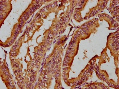 IHC image of MICAL1 Antibody diluted at 1:200 and staining in paraffin-embedded human endometrial cancer performed on a Leica BondTM system. After dewaxing and hydration, antigen retrieval was mediated by high pressure in a citrate buffer (pH 6.0). Section was blocked with 10% normal goat serum 30min at RT. Then primary antibody (1% BSA) was incubated at 4°C overnight. The primary is detected by a biotinylated secondary antibody and visualized using an HRP conjugated SP system.