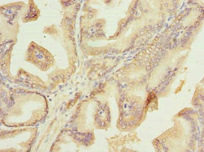 Immunohistochemistry of paraffin-embedded human prostate cancer using Plet1 Antibody at dilution of 1:100Rabbit anti-Mus musculus (Mouse) Plet1 Polyclonal Antibody