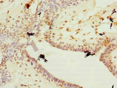 Immunohistochemistry of paraffin-embedded human breast cancer using Plet1 Antibody at dilution of 1:100Rabbit anti-Mus musculus (Mouse) Plet1 Polyclonal Antibody