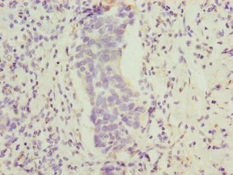 Immunohistochemistry of paraffin-embedded human bladder cancer using FAM222B Antibody at dilution of 1:100Rabbit anti-Human FAM222B Polyclonal Antibody
