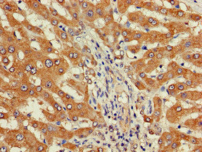 Immunohistochemistry of paraffin-embedded human liver cancer using DEPDC1B Antibody at dilution of 1:100Rabbit anti-Human DEPDC1B Polyclonal Antibody