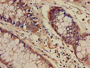 Immunohistochemistry of paraffin-embedded human colon cancer using WASF1 Antibody at dilution of 1:100Rabbit anti-Human WASF1 Polyclonal Antibody