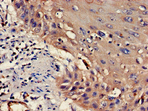 Immunohistochemistry of paraffin-embedded human cervical cancer using WASF1 Antibody at dilution of 1:100Rabbit anti-Human WASF1 Polyclonal Antibody