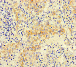 Immunohistochemistry of paraffin-embedded human lung cancer using the antibody at dilution of 1:100Rabbit anti-Human NEO1 Polyclonal Antibody
