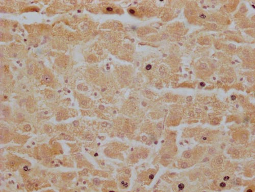 IHC image of MR1 Antibody diluted at 1:200 and staining in paraffin-embedded human liver tissue performed on a Leica BondTM system. After dewaxing and hydration, antigen retrieval was mediated by high pressure in a citrate buffer (pH 6.0). Section was blocked with 10% normal goat serum 30min at RT. Then primary antibody (1% BSA) was incubated at 4°C overnight. The primary is detected by a Goat anti-rabbit polymer IgG labeled by HRP and visualized using 0.05% DAB.Rabbit anti-Human MR1 Polyclonal Antibody