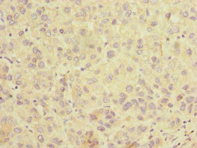 Immunohistochemistry of paraffin-embedded human liver cancer using SLC25A36 Antibody at dilution of 1:100Rabbit anti-Human SLC25A36 Polyclonal Antibody