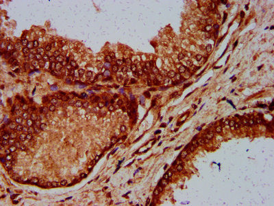 IHC image of ELP4 Antibody diluted at 1:600 and staining in paraffin-embedded human prostate cancer performed on a Leica BondTM system. After dewaxing and hydration, antigen retrieval was mediated by high pressure in a citrate buffer (pH 6.0). Section was blocked with 10% normal goat serum 30min at RT. Then primary antibody (1% BSA) was incubated at 4°C overnight. The primary is detected by a biotinylated secondary antibody and visualized using an HRP conjugated SP system.Rabbit anti-Human ELP4 Polyclonal Antibody