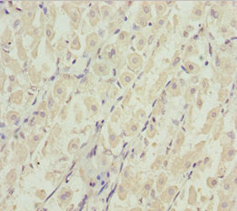 Immunohistochemistry of paraffin-embedded human gastric cancer using DDX11 Antibody at dilution of 1:100Rabbit anti-Human DDX11 Polyclonal Antibody