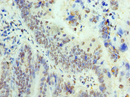 Immunohistochemistry of paraffin-embedded human colon cancer using THOC1 Antibody at dilution of 1:100Rabbit anti-Human THOC1 Polyclonal Antibody