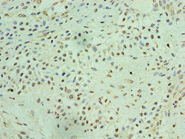 Immunohistochemistry of paraffin-embedded human breast cancer using THOC1 Antibody at dilution of 1:100Rabbit anti-Human THOC1 Polyclonal Antibody