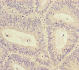 Immunohistochemistry of paraffin-embedded human colon cancer using RBM17 Antibody at dilution of 1:100Rabbit anti-Human RBM17 Polyclonal Antibody
