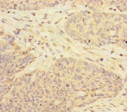 Immunohistochemistry of paraffin-embedded human ovarian cancer using RBM17 Antibody at dilution of 1:100Rabbit anti-Human RBM17 Polyclonal Antibody