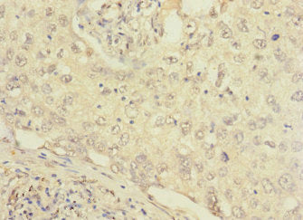 Immunohistochemistry of paraffin-embedded human lung cancer using FCRL2 Antibody at dilution of 1:100