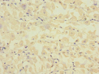Immunohistochemistry of paraffin-embedded human gastric cancer using FCRL2 Antibody at dilution of 1:100
