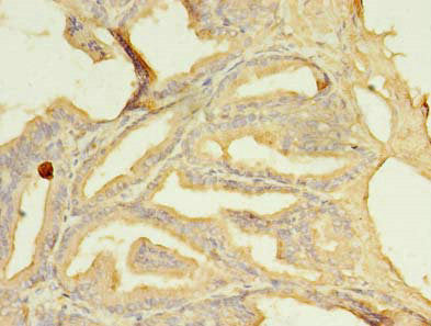 Immunohistochemistry of paraffin-embedded human prostate cancer using the antibody at dilution of 1:100Rabbit anti-Human SFXN2 Polyclonal Antibody