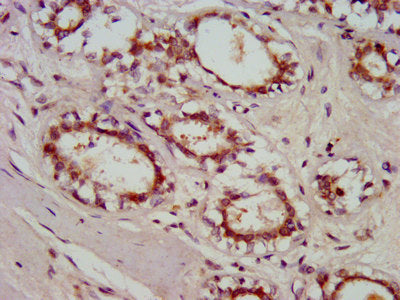 IHC image of GBP4 Antibody diluted at 1:800 and staining in paraffin-embedded human breast cancer performed on a Leica BondTM system. After dewaxing and hydration, antigen retrieval was mediated by high pressure in a citrate buffer (pH 6.0). Section was blocked with 10% normal goat serum 30min at RT. Then primary antibody (1% BSA) was incubated at 4°C overnight. The primary is detected by a biotinylated secondary antibody and visualized using an HRP conjugated SP system.Rabbit anti-Human GBP4 Polyclonal Antibody