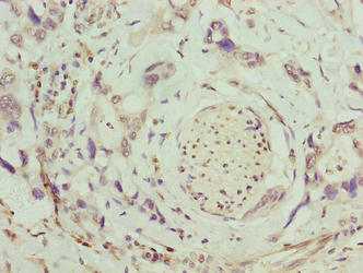 Immunohistochemistry of paraffin-embedded human pancreatic cancer using SLC26A8 Antibody at dilution of 1:100Rabbit anti-Human SLC26A8 Polyclonal Antibody