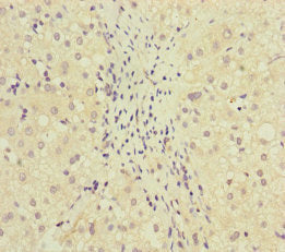 Immunohistochemistry of paraffin-embedded human liver cancer using the antibody at dilution of 1:100