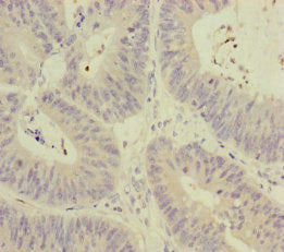 Immunohistochemistry of paraffin-embedded human colon cancer using MCCC1 Antibody at dilution of 1:100