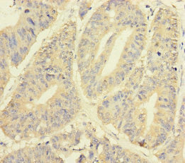Immunohistochemistry of paraffin-embedded human colon cancer using YME1L1 Antibody at dilution of 1:100Rabbit anti-Human YME1L1 Polyclonal Antibody