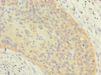 Immunohistochemistry of paraffin-embedded human cervical cancer using OXR1 Antibody at dilution of 1:100Rabbit anti-Human OXR1 Polyclonal Antibody