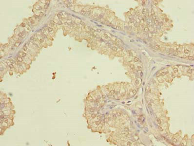 Immunohistochemistry of paraffin-embedded human prostate cancer using PQLC3 Antibody at dilution of 1:100Rabbit anti-Human PQLC3 Polyclonal Antibody