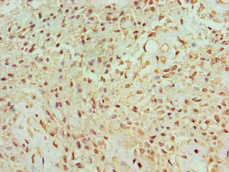 Immunohistochemistry of paraffin-embedded human breast cancer using BANP Antibody at dilution of 1:100