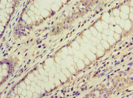 Immunohistochemistry of paraffin-embedded human colon cancer using ACVR1C Antibody at dilution of 1:100Rabbit anti-Human ACVR1C Polyclonal Antibody