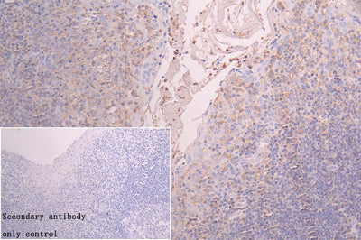 Immunohistochemistry of paraffin-embedded human liver cancer using FBXO22 Antibody at dilution of 1:100Rabbit anti-Human FBXO22 Polyclonal Antibody