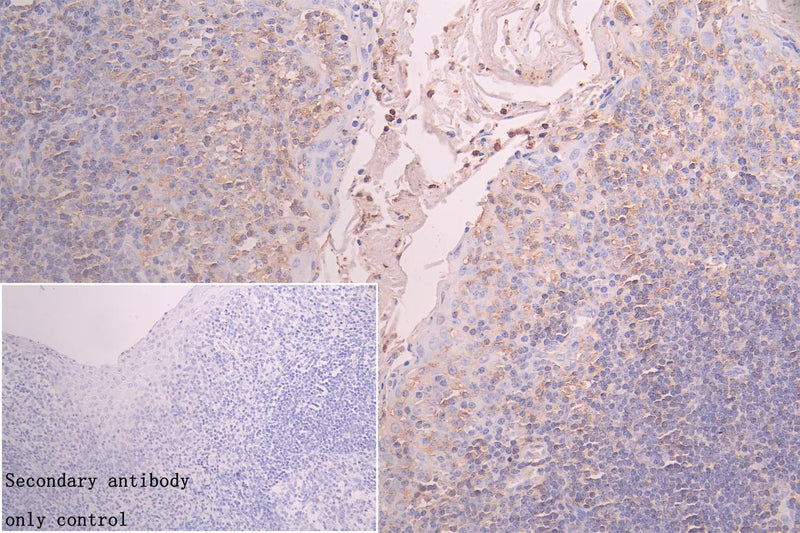 Immunohistochemistry of paraffin-embedded human liver cancer using FBXO22 Antibody at dilution of 1:100Rabbit anti-Human FBXO22 Polyclonal Antibody