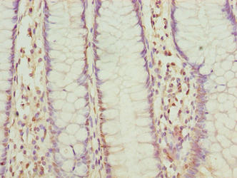 Immunohistochemistry of paraffin-embedded human colon cancer using FLAD1 Antibody at dilution of 1:100Rabbit anti-Human FLAD1 Polyclonal Antibody