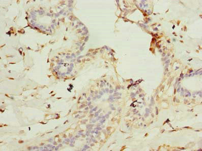 Immunohistochemistry of paraffin-embedded human breast cancer using CEP76 Antibody at dilution of 1:100Rabbit anti-Human CEP76 Polyclonal Antibody