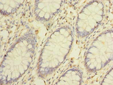 Immunohistochemistry of paraffin-embedded human colon cancer using CEP76 Antibody at dilution of 1:100Rabbit anti-Human CEP76 Polyclonal Antibody